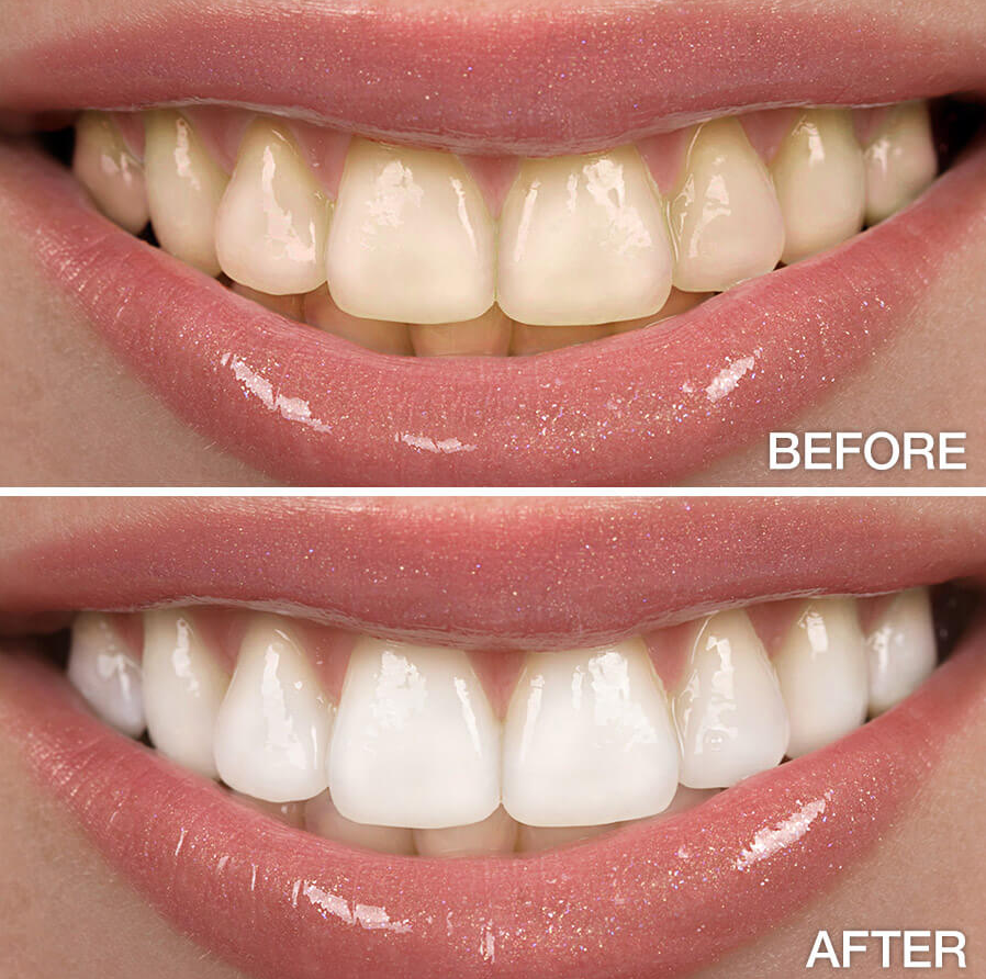 Professional Tooth Whitening and Bleaching Service at Kashmira's Dental Care Andheri East