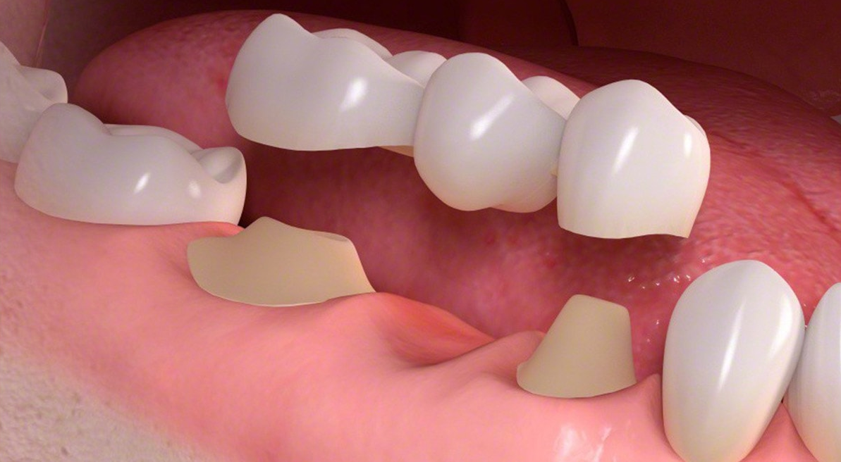 Dental Bridge Treatment at Kashmira's Dental Care Andheri East