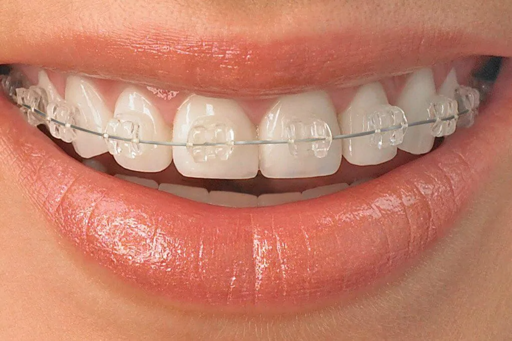 Cosmetic Ceramic Braces Treatment at Kashmira's Dental Care Andheri East