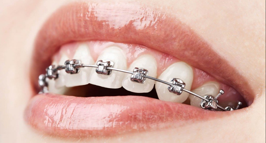 Metal Braces Orthodontic Treatment at Kashmira's Dental Care Andheri East