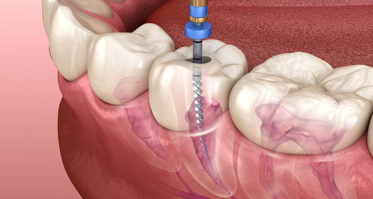 Painless Root Canal Treatment by Expert Dentist at Kashmira's Dental Care Andheri East