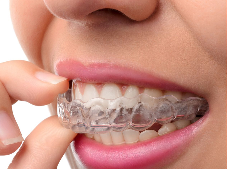 Clear tooth aligners treatment in Andheri East