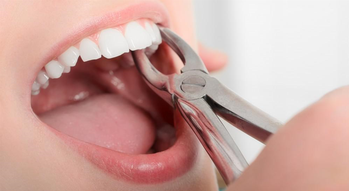 Safe Tooth Extraction and Oral Surgery at Kashmira's Dental Care Andheri East