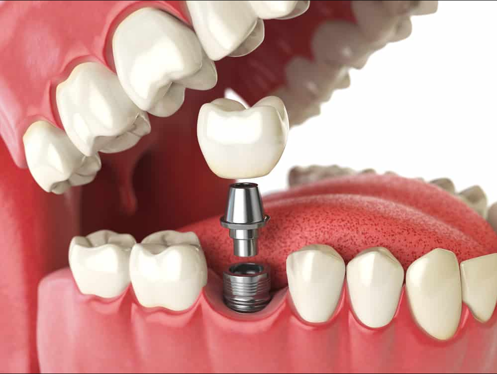 Dental implant treatment in Andheri East